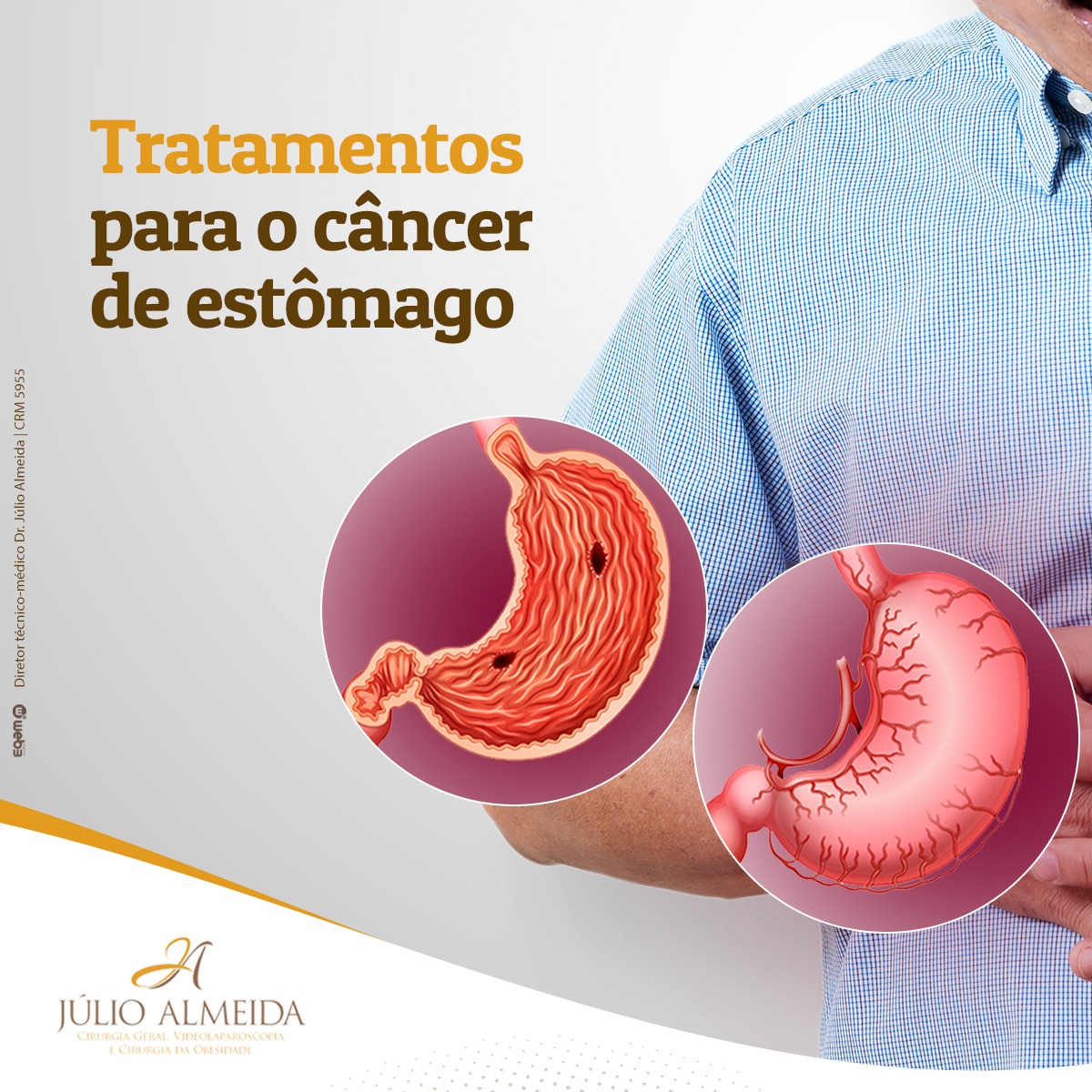 Tratamentos para o câncer de estômago