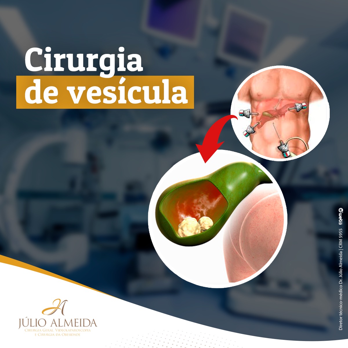 Cirurgia de vesícula