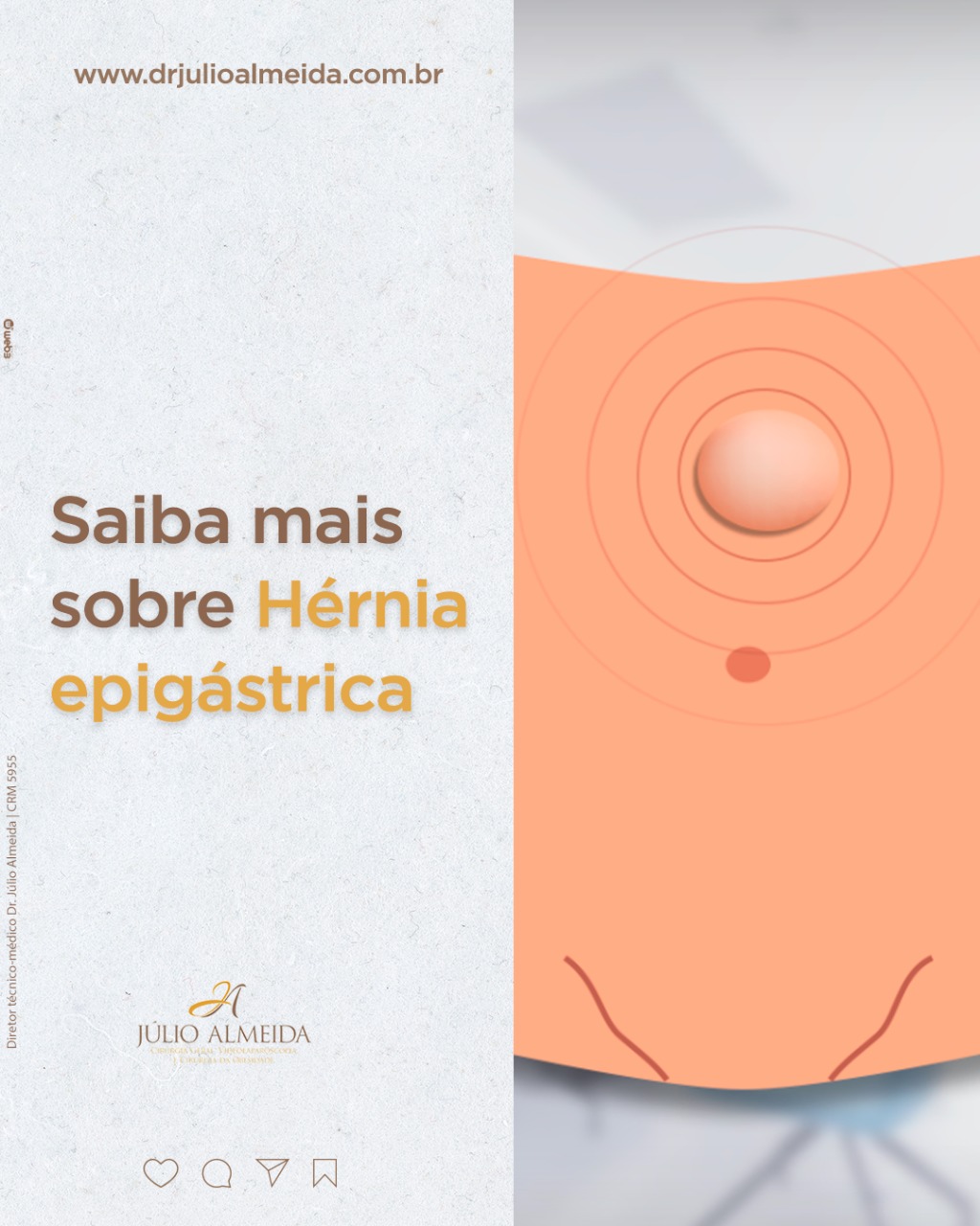 Dr Alexandre - Saiba mais sobre hérnia epigástrica